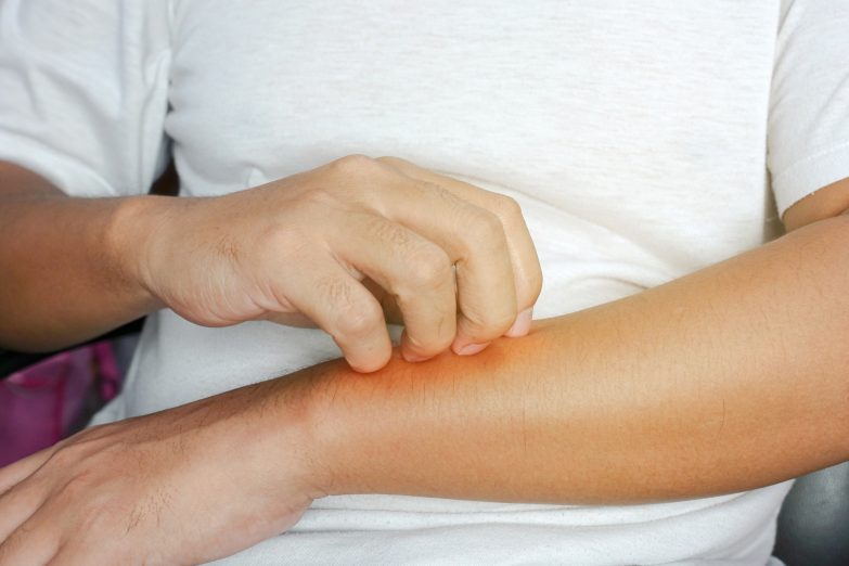 Itchy skin - contact dermatitis